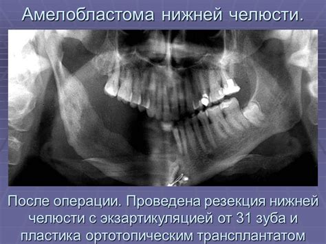 Доброкачественные одонтогенные и неодонтогенные опухоли челюстей ...