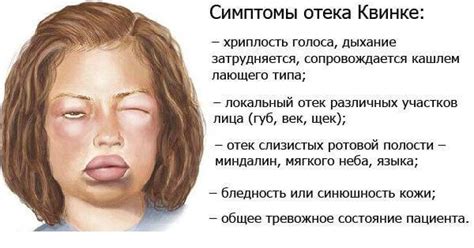 Отек квинке: симптомы и лечение в домашних условиях, фото больных