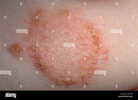 Mild Impetigo Treatment