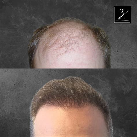 hair transplant san francisco virtual consultations ziering medical