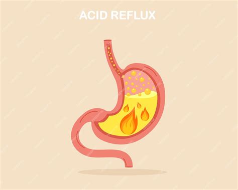 Premium Vector | Suffering from gerd with acid reflux stomach heartburn
