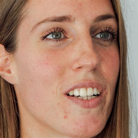 Kristina is 28 and lives in Denmark. She has been struggling with acne ...