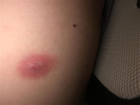 Bug bite identification - General Discussion - Neowin