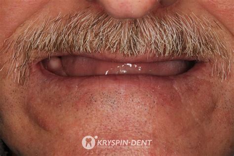 Całkowity brak zębów - Kryspin-dent
