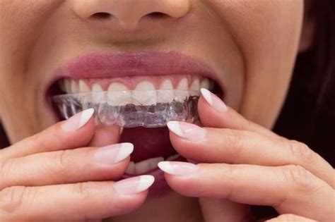 Научете повече за лечението с алайнери | Deckoff Dental