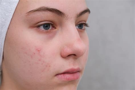 ニキビ跡の種類と治療法について解説します！ | まゆりなclinic名古屋栄