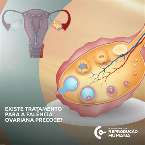 Falencia Ovariana Precoce - Existe tratamento para a falência ovariana precoce? - Núcleo Santista ...