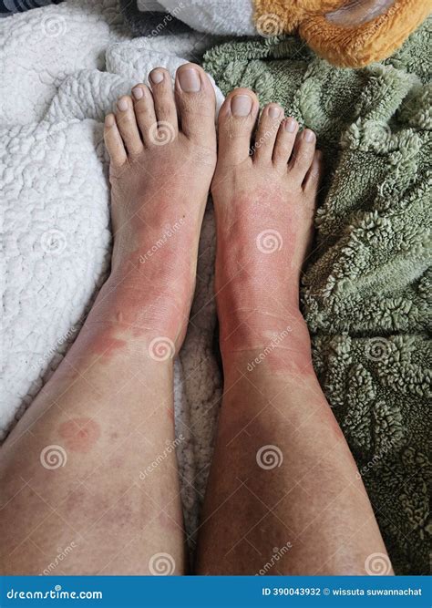 Urticaria Or Hives On The Back, On The Shoulder Red Rashes, Itchy Bumps