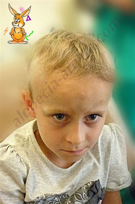 Pin on Результаты лечения выпадения волос и алопеции в Международном ...