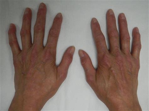 Herbal Remedies Treatment For Crest Syndrome
