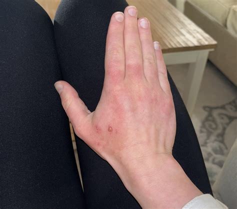 Fluid filled blisters on hands : r/DermatologyQuestions
