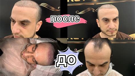 10-й день после пересадки волос!Как выглядит пациент после пересадки ...