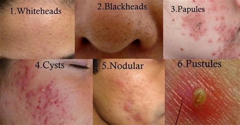 Papules And Pustules
