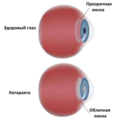 Катаракта – причины, симптомы и лечение заболевания - Estet-Portal