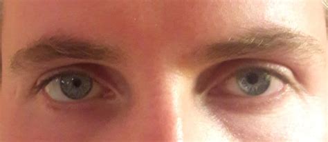 Sluggish Pupils