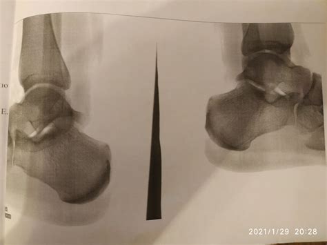 Боль в пятках, устают ноги | Консультация ортопеда в Минске на DOKTORA ...
