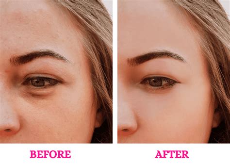 Under Eye Fillers - Silkee Skin & Hair Clinic