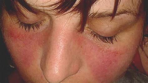 lupus rash  rosacea symptoms  treatments