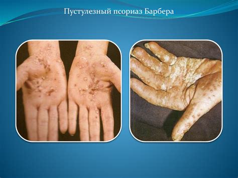 5_Лекция_псориаз,_красный_плоский_лишай - презентация онлайн
