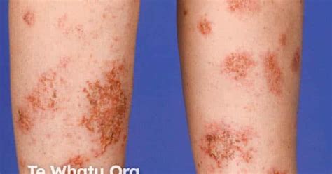 Discoid eczema image