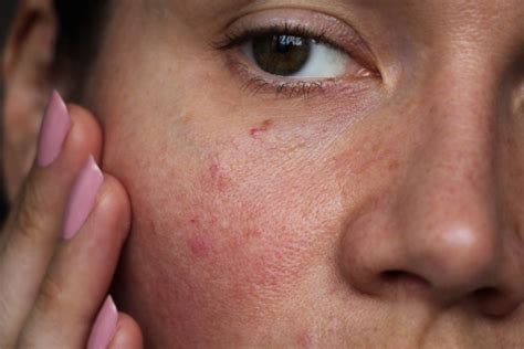 Broken Capillaries on Face: Top Treatment Devices and Results