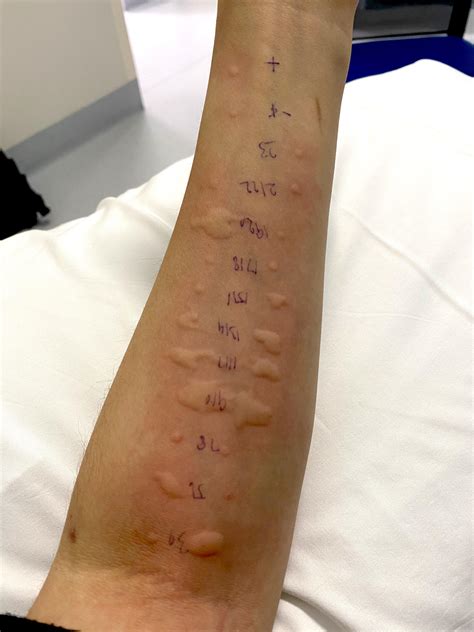 My doctor told me, “yikes, you’re a very allergic person” : r