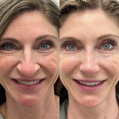 Alar Base Reduction | Face MD