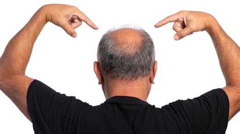 Researchers confirm the link between balding and skin cancer - Melanoma ...