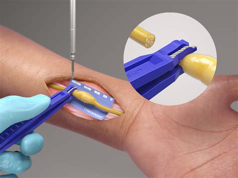 Checkpoint Surgical expands portfolio with Edge nerve cutting kit