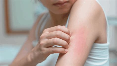 Chronic hives: Researchers identify most effective, safest treatments ...