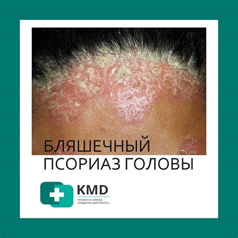 ᐈ Лечение псориаза 【Левый Берег】 Киев ~ Цены