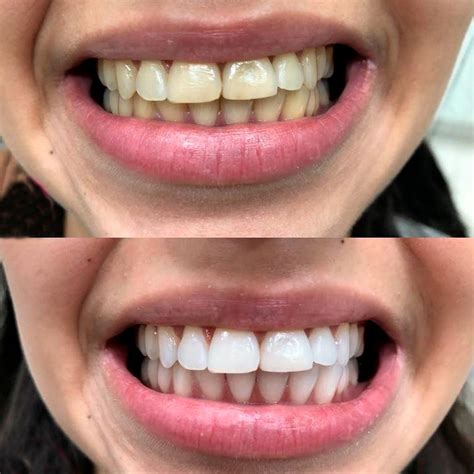 Quanto E Um Clareamento De Dentes