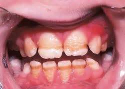 Enamel hypoplasia - Wikipedia