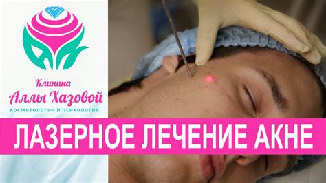 Лазерное лечение акне. Неодимовый лазер. Лечение угревой сыпи. Лечение ...
