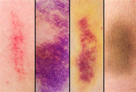 Bruise Types