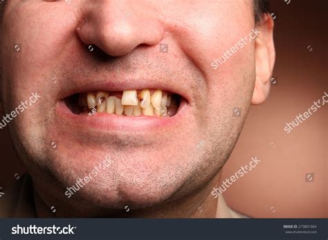 bad teeth stock photo  shutterstock