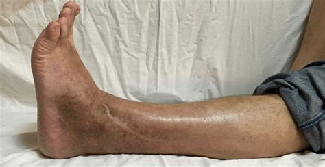 ankle arthroplasty | The Foot and Ankle Online Journal