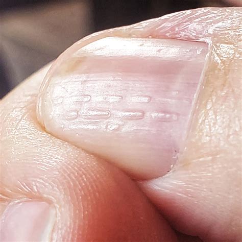 Nail Bed Ridges