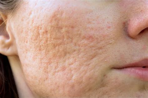 Scarring Treatment In Norwich, Norfolk - Cosmetics Doctor Norfolk
