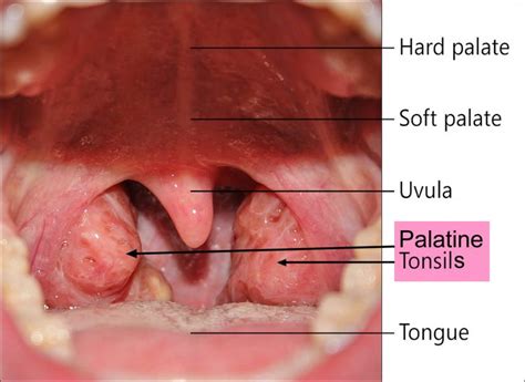 Peritonsillar abscess causes, signs, symptoms, diagnosis and treatment