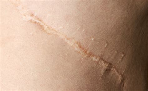 ultherapy  surgical facelift riyadh reveal clinics