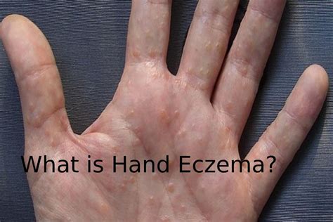 What is Hand Eczema? - Produced, Treatment, and More