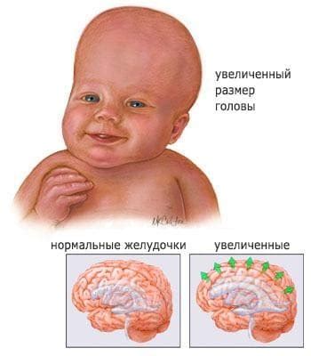 Отек головного мозга: причины, последствия, прогноз и смертность