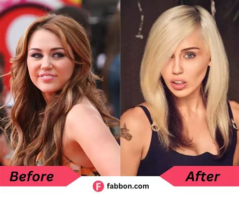 Miley Cyrus Face Transformation: 5 Surgeries Explain Everything | Fabbon