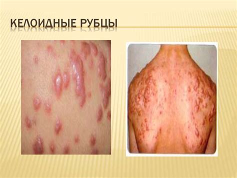 Вульгарные угри. Акне или угревая болезнь - презентация онлайн