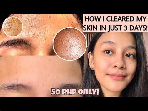 how to get rid of tiny bumps on forehead