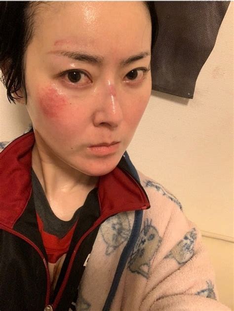 遠野なぎこ、顔が傷だらけの時の写真を公開「気をつけなきゃだね」 | エンタメ総合 | ABEMA TIMES | アベマタイムズ