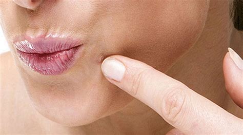 5 эффективных методик, чтобы избавиться от папиллом