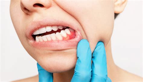Gengiva Crescendo Por Cima Do Dente
