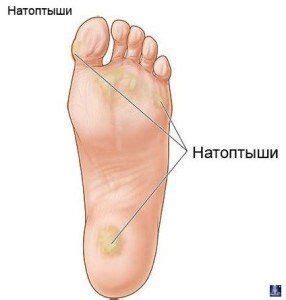 Часто на подошве ног появляются огрубевшие участки – натоптыши. Размеры ...